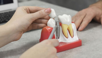 5 Important Things You Didn’t Know About Dental Implants