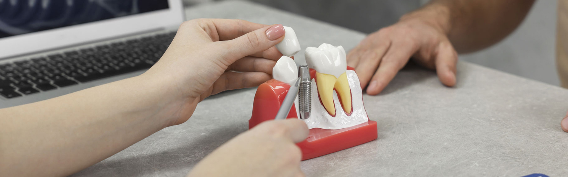 5 Important Things You Didn’t Know About Dental Implants