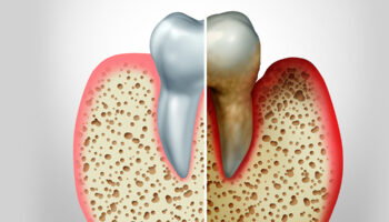 Can Decayed Teeth Affect Your Heart?